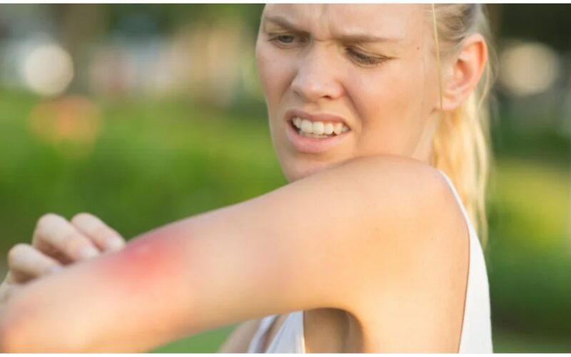 Urgent warning over insect bites and stings - symptoms & when to get emergency help