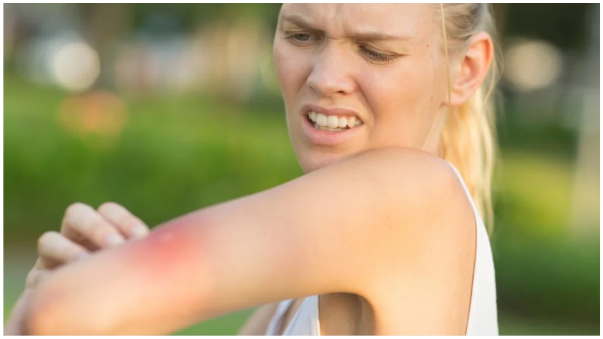 Urgent warning over insect bites and stings - symptoms & when to get emergency help